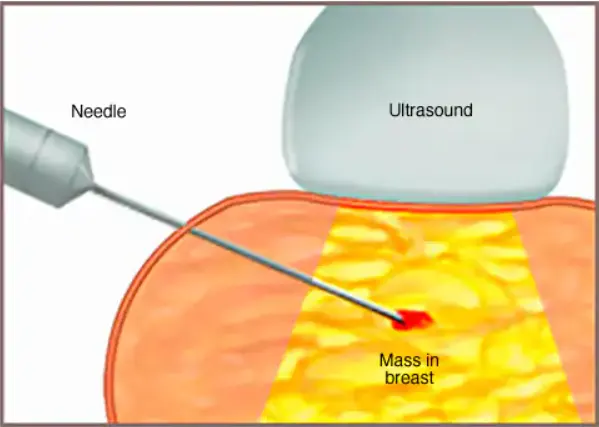 core-needle-biopsy_mayo-clinic.webp